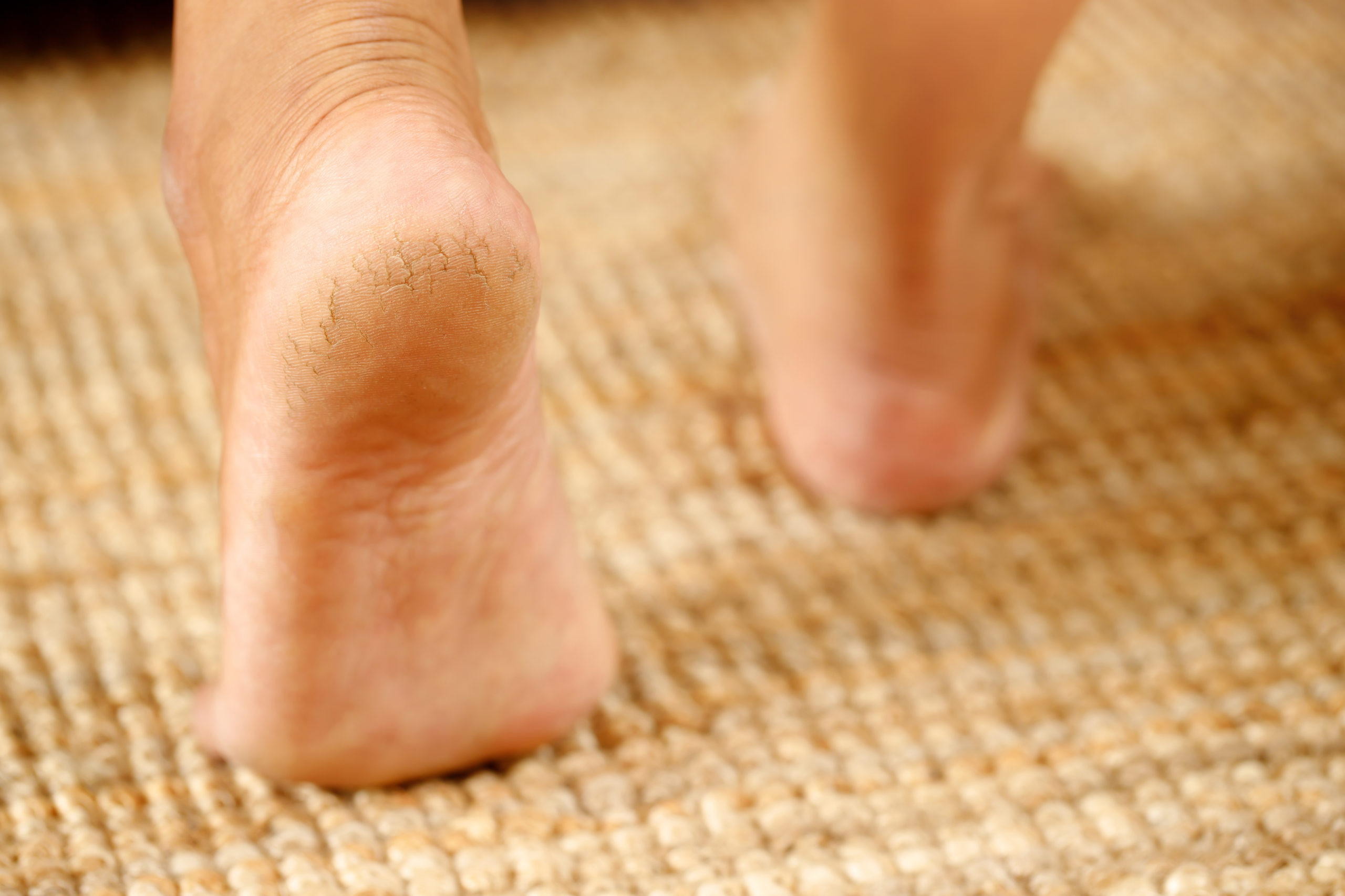 5 Home Solutions to Prevent and Treat Cracked Heels | Banner