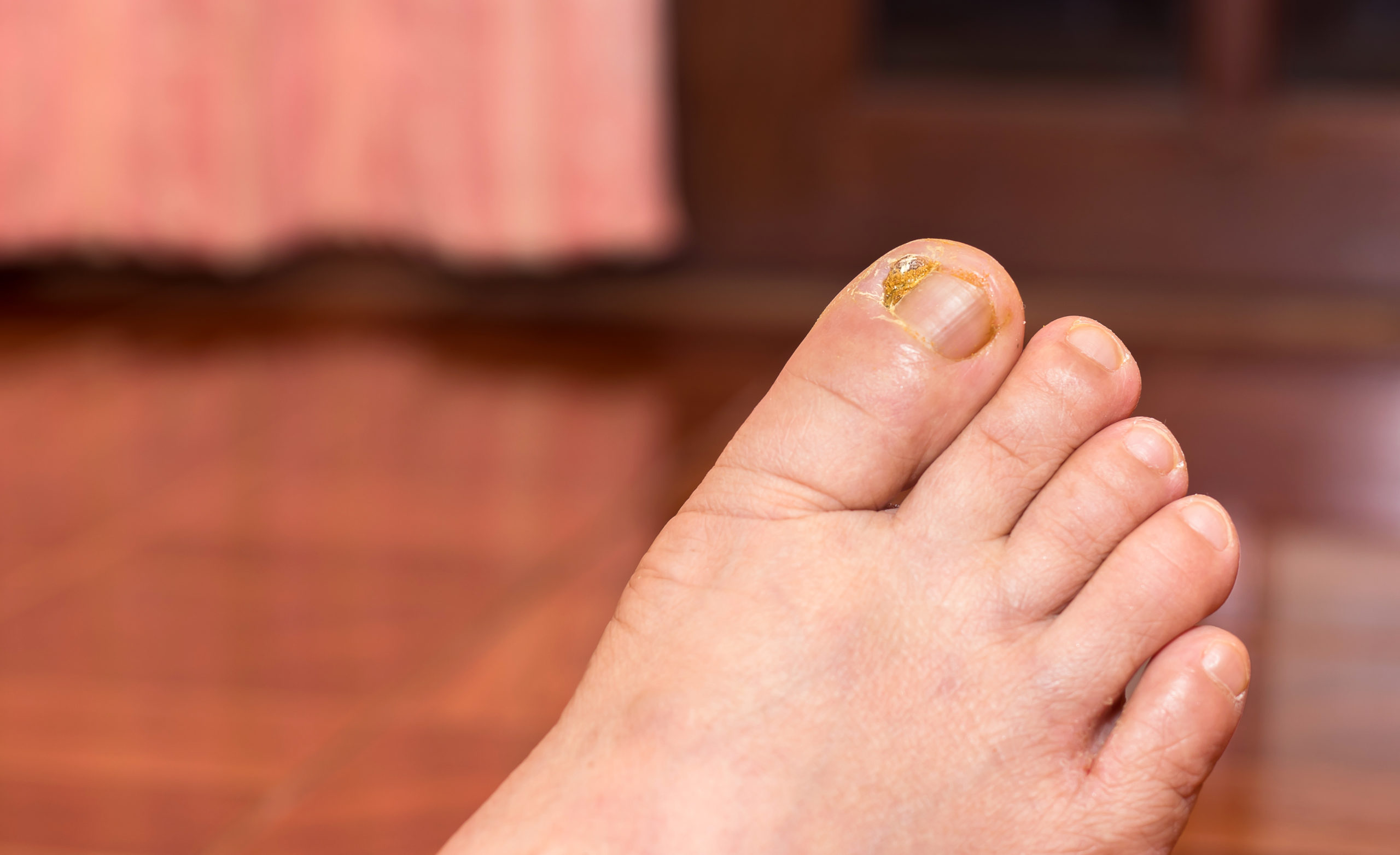 Nail Problems - Normal, IL & Pontiac, IL: Cortese Foot & Ankle Clinic